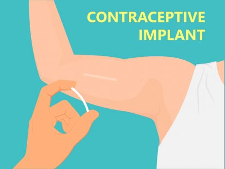 Birth Control Implant | Nexplanon | Risks And Side Effects.