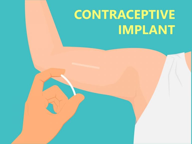 Birth Control Implant Nexplanon Risks And Side Effects.