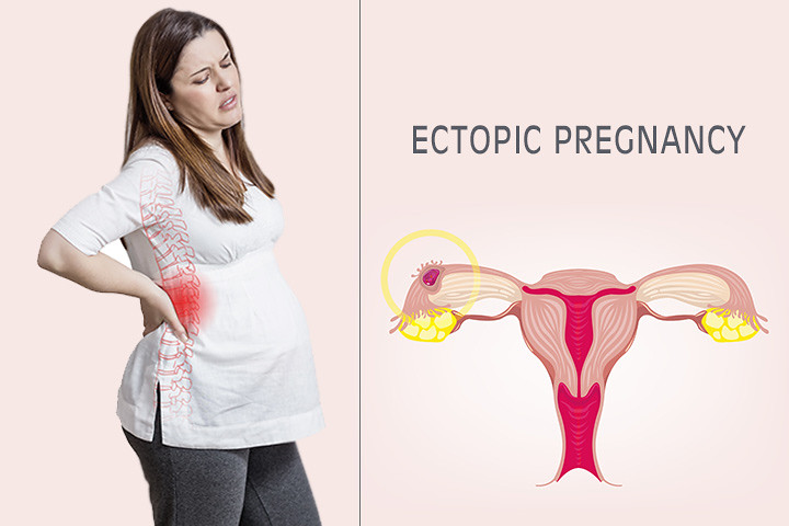 Ectopic Pregnancies VS State Bans On Abortion Care.